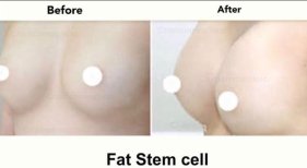 Before and after Увеличение груди photos by Dr. Pimpchaya Panichkul 