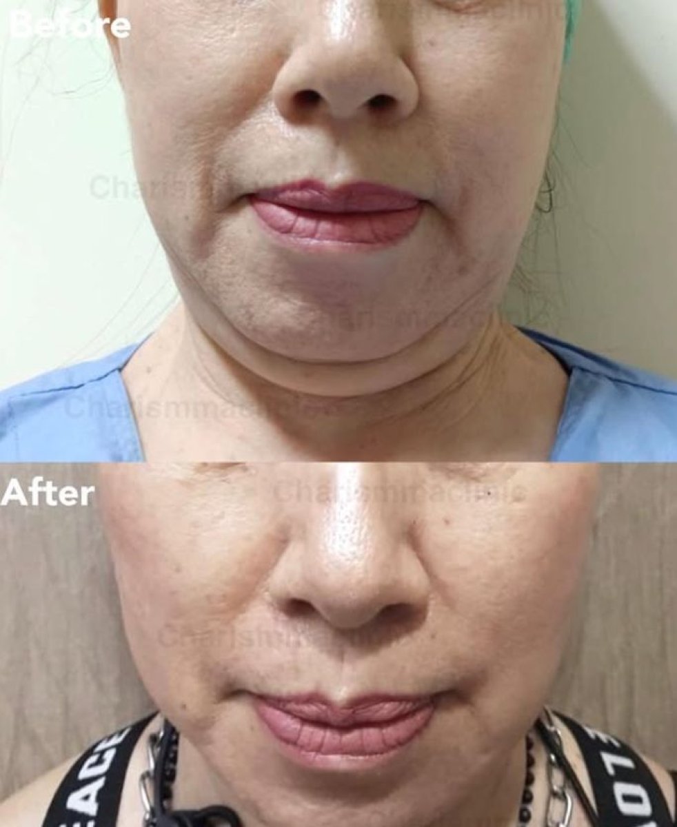 نتائج شفط دهون الذقن قبل وبعد في Charismma Clinic، تحديد الفك المحسن
