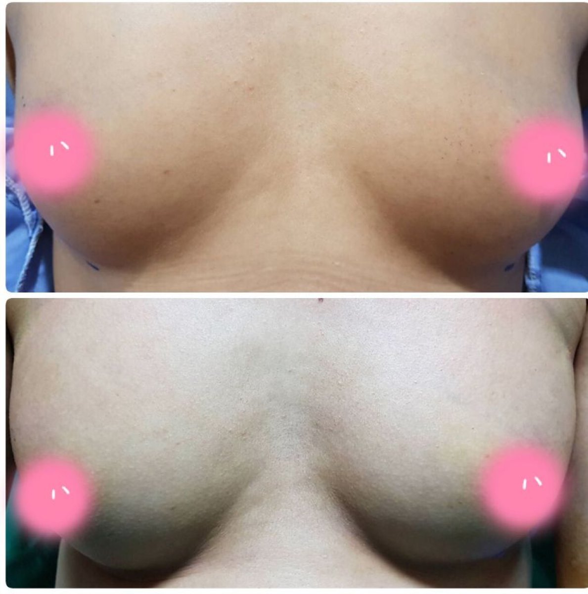 Before and after breast augmentation results at Charismma Clinic, enhanced breast volume