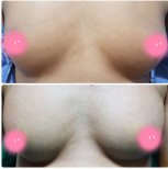 Before and after Увеличение груди photos by Dr. Pimpchaya Panichkul 