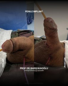 Premium Penile implant surgery All Included - photo 4