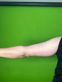 Standard Liposuction with a special discount - photo 3