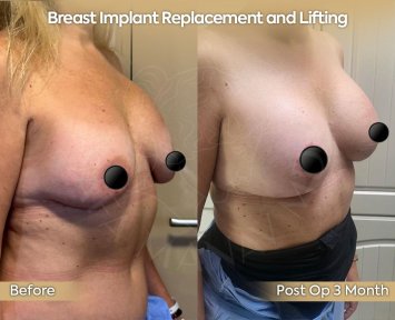Premium Mommy Makeover Surgery-All Incluisive with European Board Certified Doctor Ali Sadioglu - photo 3