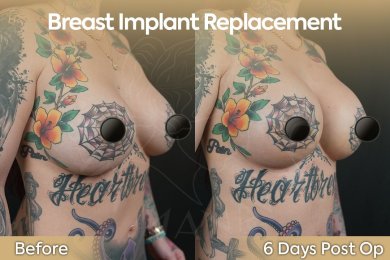 Premium Mommy Makeover Surgery-All Incluisive with European Board Certified Doctor Ali Sadioglu - photo 2