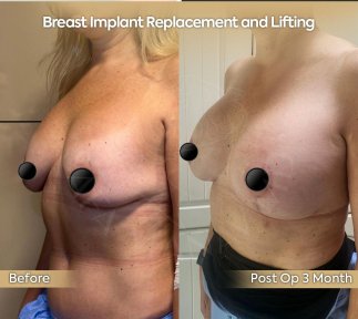 Premium Mommy Makeover Surgery-All Incluisive with European Board Certified Doctor Ali Sadioglu