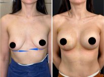 Before and after Вазер (Vaser) липосакция photos by Dr. Ali Sadioglu Md