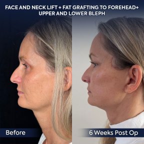 Premium Face&Neck lift + Upper Blephasroplasty+ Fat Transfer to Face Surgery -All Incluisive with European Board Certified Doctor Ali Sadioglu - photo 2