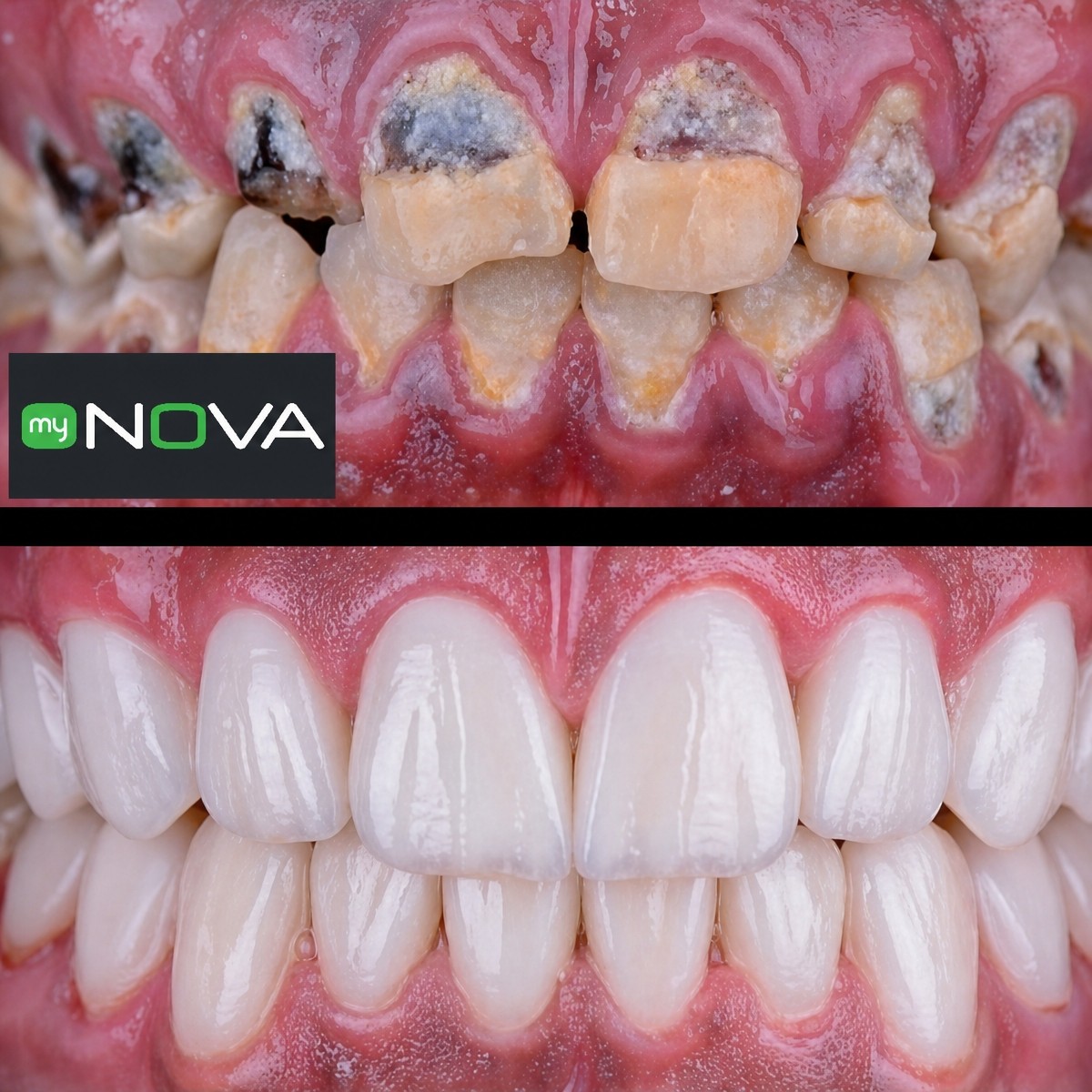 نتيجة قبل وبعد زراعة الأسنان All-on-6 في My Nova Kusadasi Dental Clinic، ابتسامة مستعادة