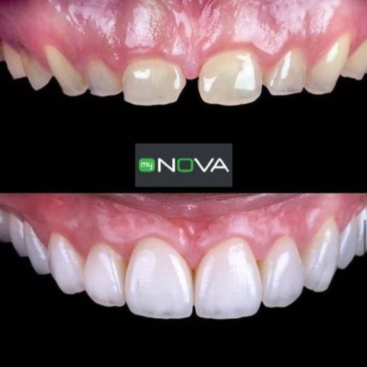 نتيجة قبل وبعد زراعة الأسنان All-on-6 في My Nova Kusadasi Dental Clinic، ابتسامة مستعادة