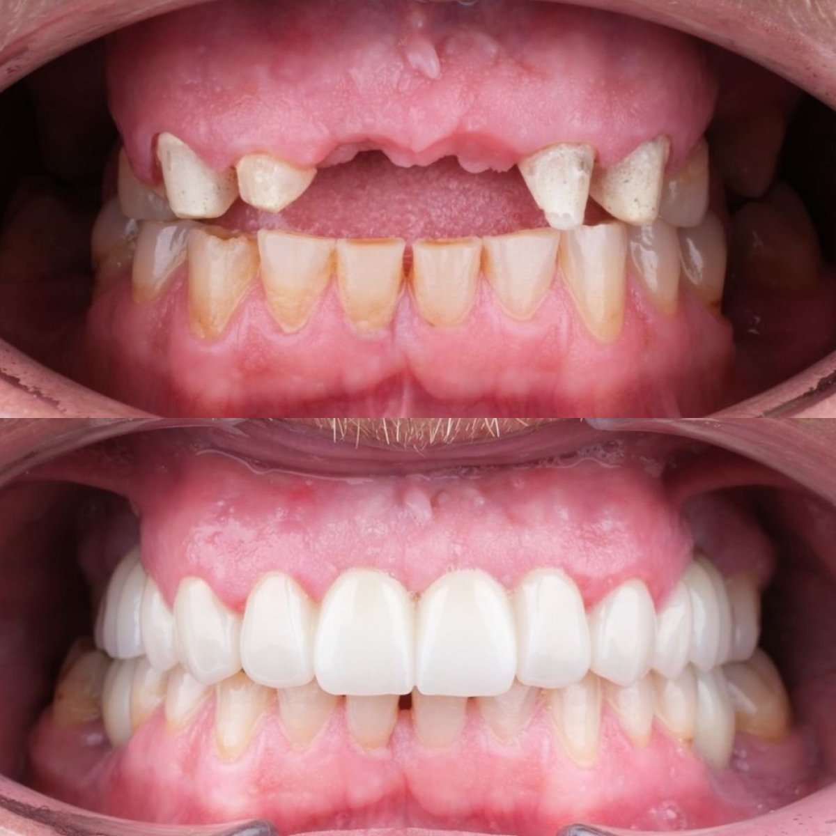Результат до и после имплантации All-on-6 в My Nova Kusadasi Dental Clinic, восстановление улыбки