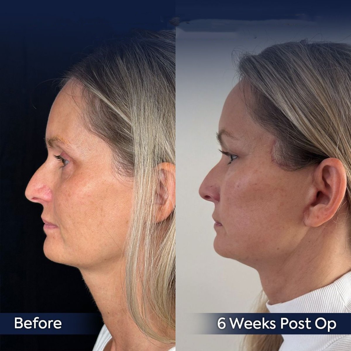 Before and after forehead contouring results at Dr. Safa Manav Clinic, 6 weeks post-op