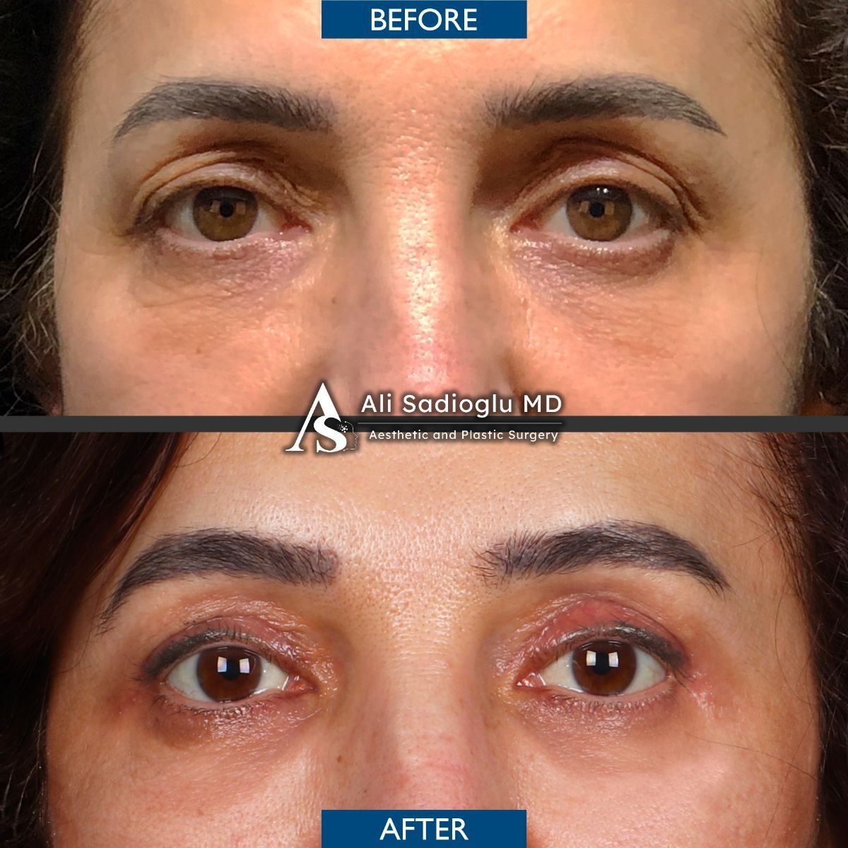 Resultados de blefaroplastia superior antes y después en Dr. Safa Manav Clinic, área rejuvenecida