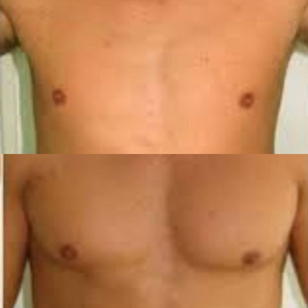 Before and after pectoral implants at ID Clinic Bangkok, enhanced chest contour results