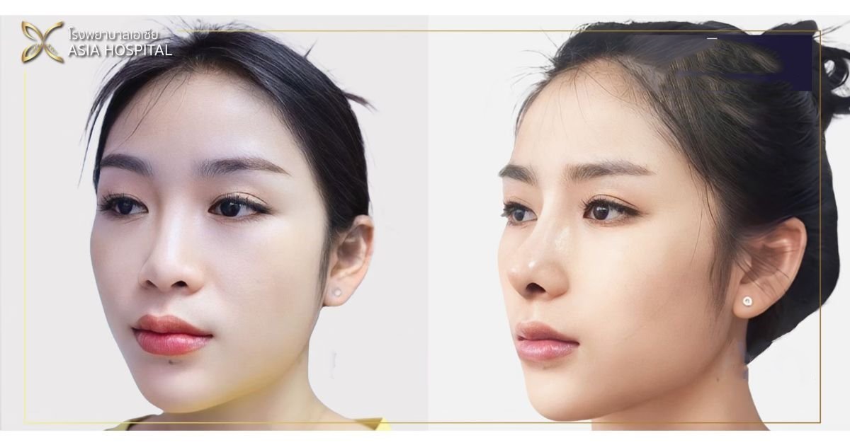 Before and after revision rhinoplasty results at Asia Cosmetic Hospital, improved nose contour