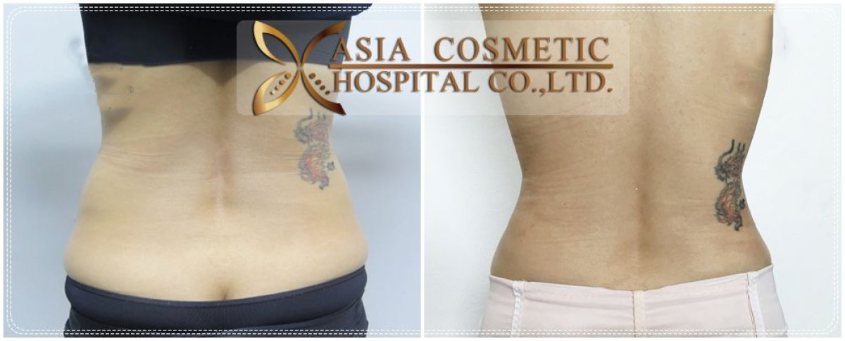 Before and after liposuction results at Asia Cosmetic Hospital, visible waist contour improvement