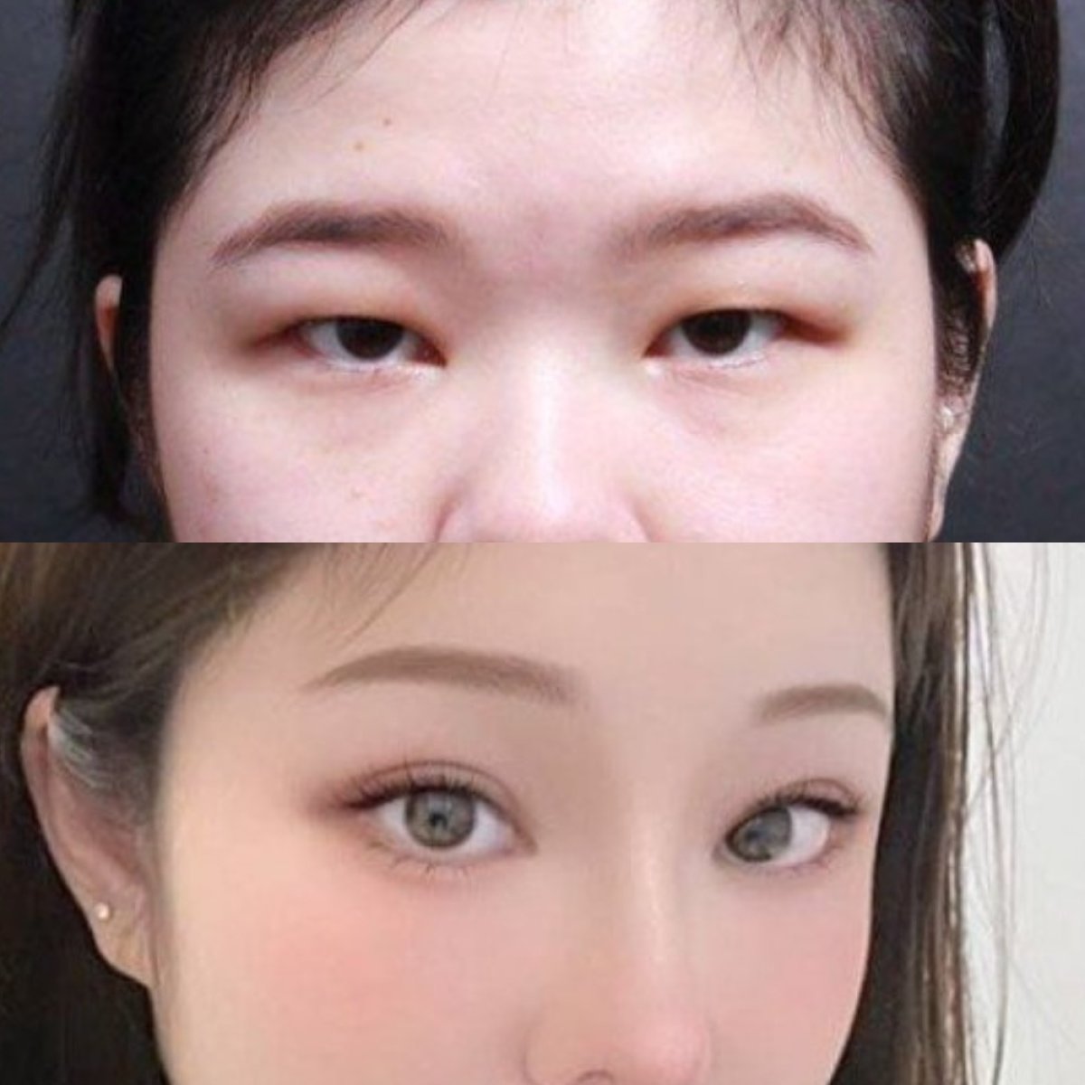 نتائج قبل وبعد جراحة الجفن المتدلي في VG Plastic Surgery، مظهر عين محسّن