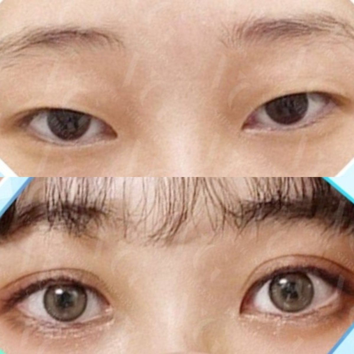 نتائج قبل وبعد جراحة الجفن المتدلي في VG Plastic Surgery، مظهر عين محسّن