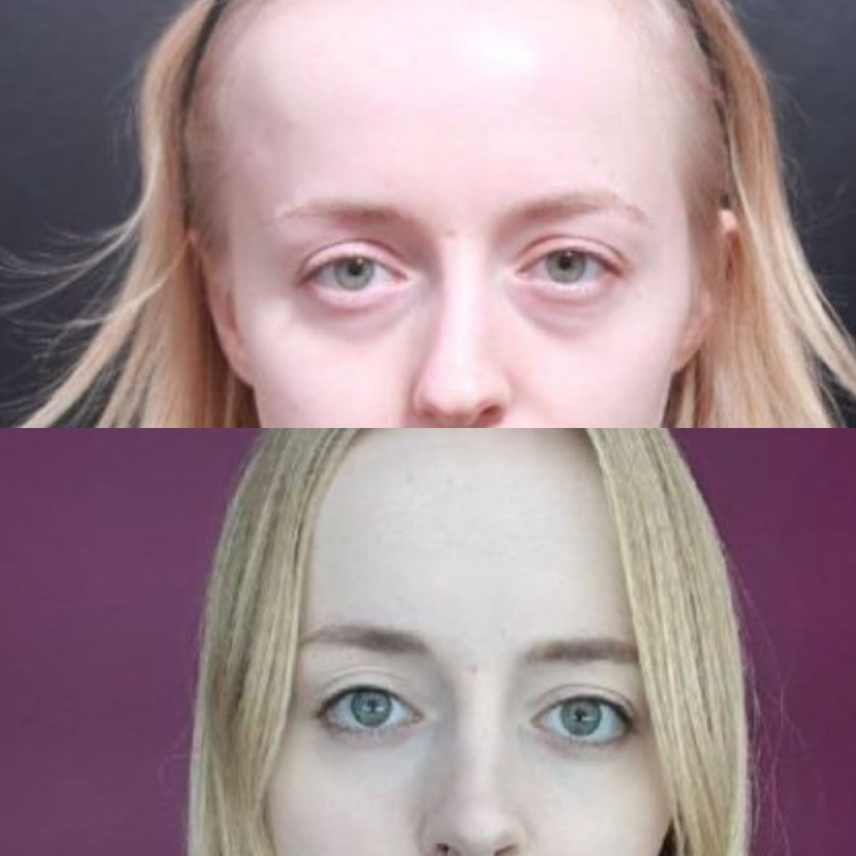 نتائج قبل وبعد جراحة الجفن المتدلي في VG Plastic Surgery، مظهر عين محسّن