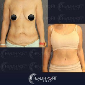 Breast Reduction - photo 6