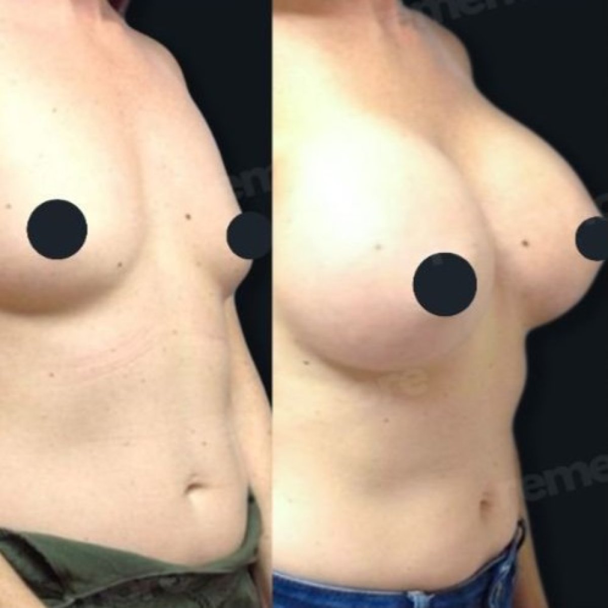 Before and after breast implant revision results at Memorial Şişli Hospital, enhanced shape