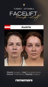 Standard Blepharoplasty (Eyelid correction) with All Included