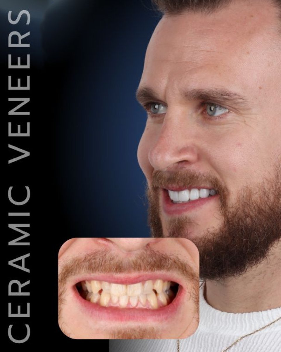 نتيجة قبل وبعد قشور الأسنان الخزفية في SmileBox Dental Clinic - Thonglor, Sukhumvit