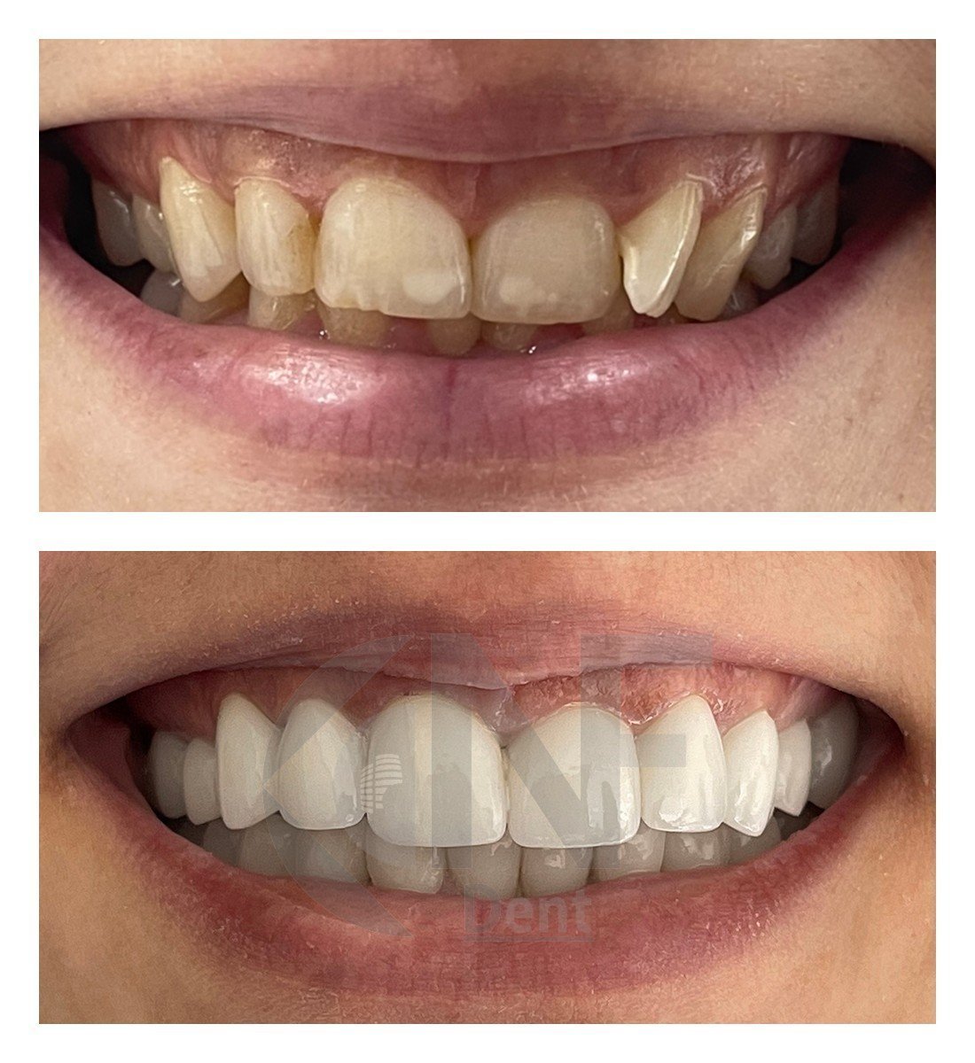 Before and after zirconia crown results at Nifa Dent International – smile makeover