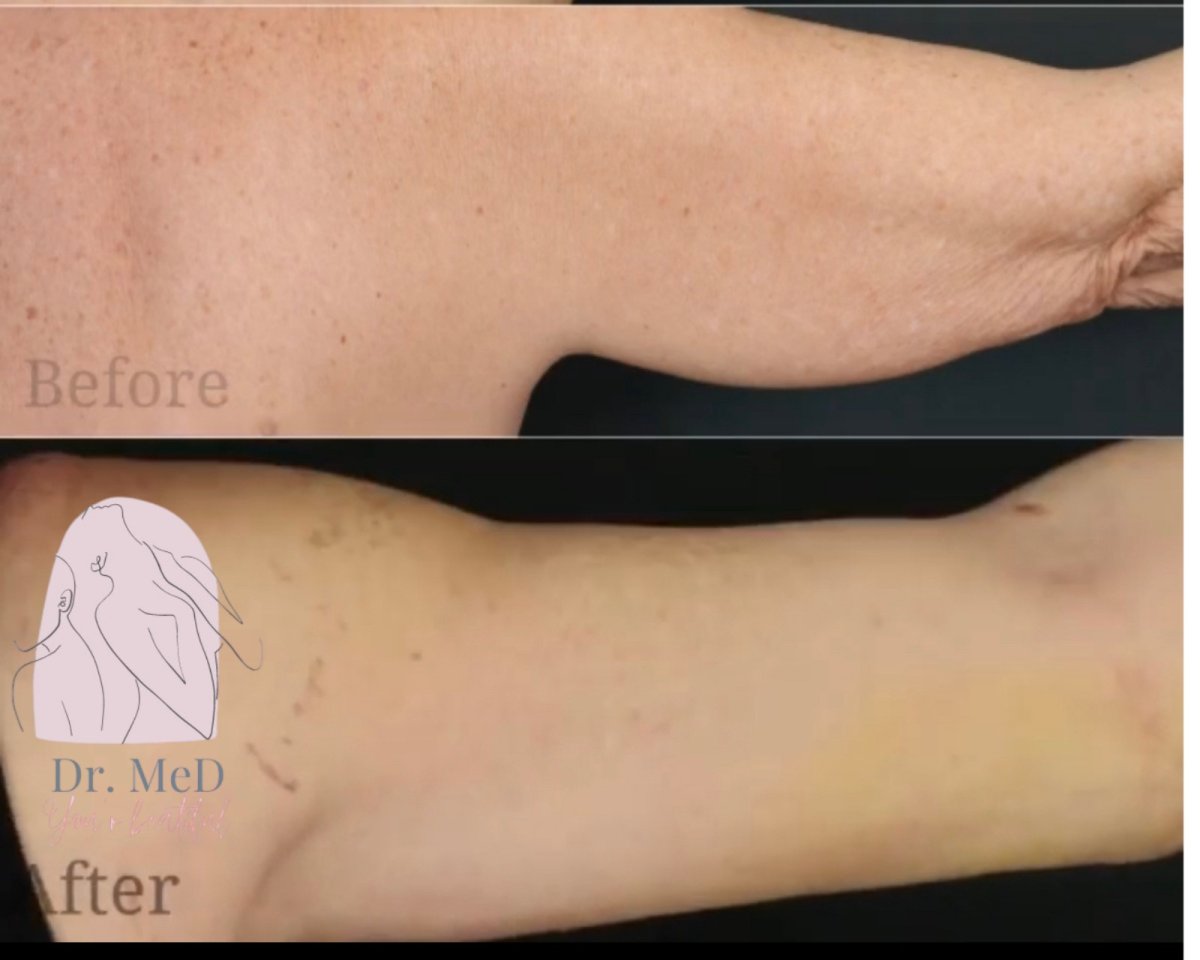 Resultados de lifting de brazos (braquioplastia) antes y después en Dr. MED – mejor contorno