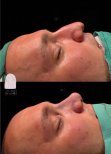 Résultats de la procédure Rhinoplastie (travail du nez) par le Dr - Photos avant et après des patients Photos avant et après par le Dr