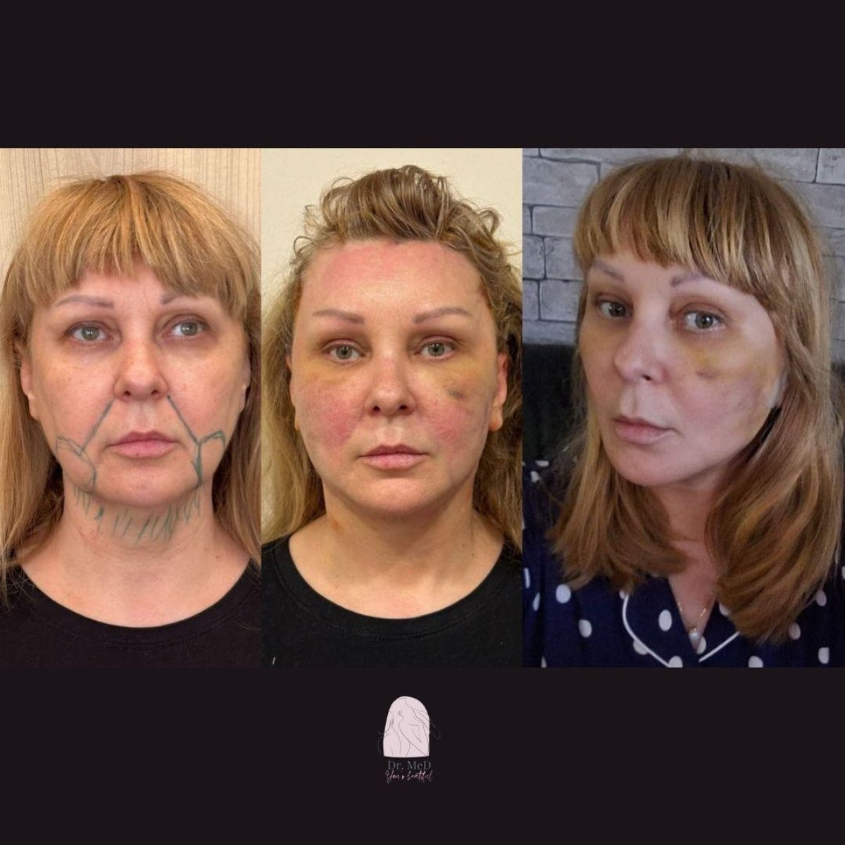 Résultats avant/après lifting du cou chez Dr. MED – amélioration du contour du visage