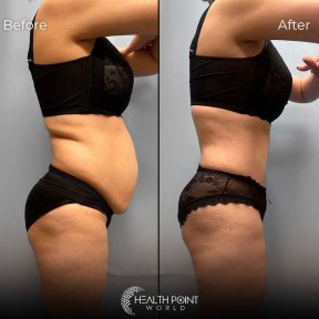 Vaser Liposuction 2-3 zones - photo 3