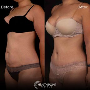 Vaser Liposuction 2-3 zones