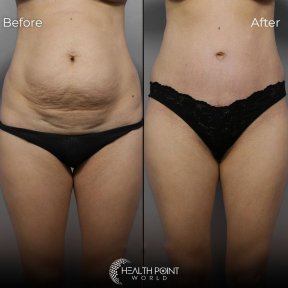 Vaser Liposuction 2-3 zones - photo 2