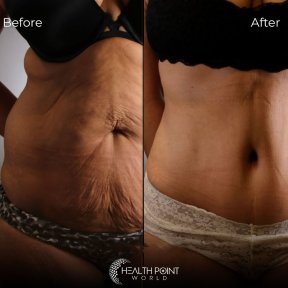 Vaser Liposuction 2-3 zones - photo 5