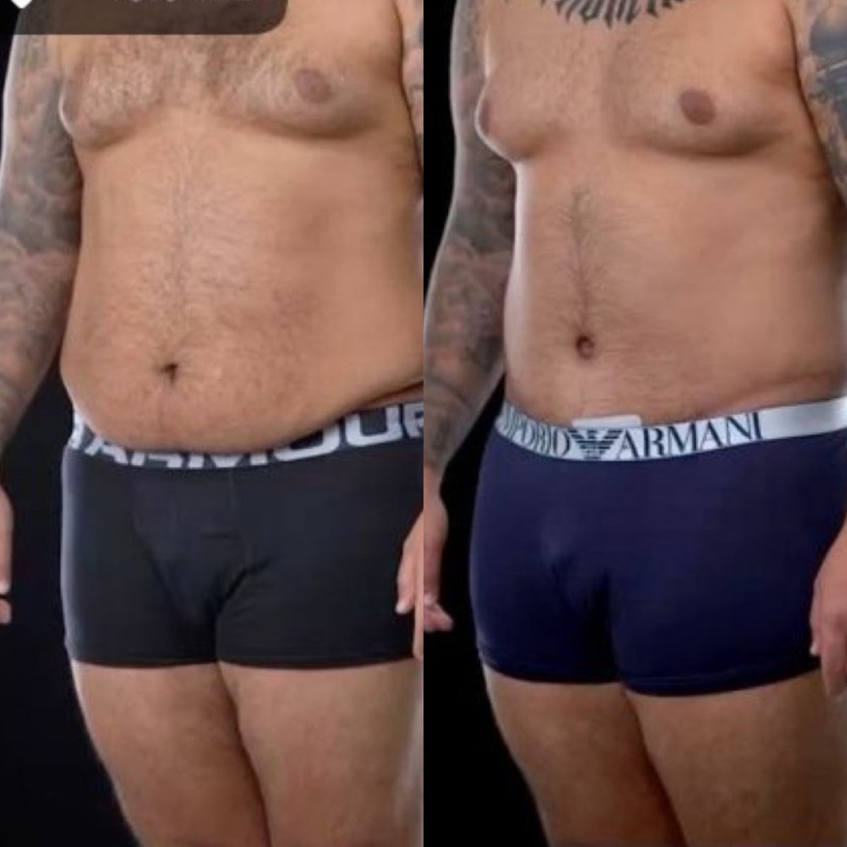 Before and after tummy tuck and liposuction results at Yurchenko Plastic Surgery Team Kyiv