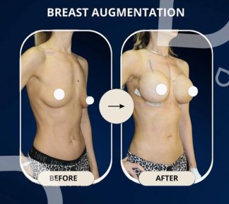 Breast Augmentation with Implants (Round) Premium All Inclusive Packages - photo 2
