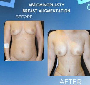 Breast Augmentation with Implants (Round) Premium All Inclusive Packages - photo 4