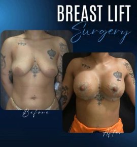 Breast Augmentation with Implants (Round) Premium All Inclusive Packages - photo 3