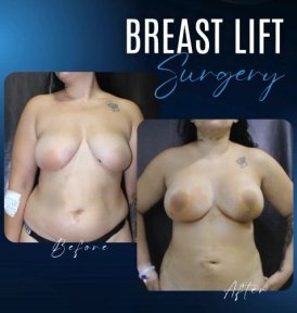 Breast Augmentation with Implants (Round) Premium All Inclusive Packages