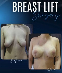 Breast Augmentation with Implants (Round) Premium All Inclusive Packages - photo 6