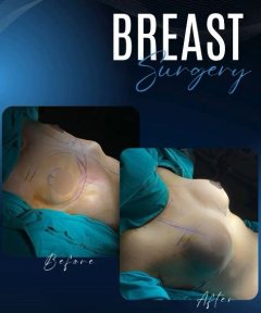 Breast Augmentation with Implants (Round) Premium All Inclusive Packages - photo 5