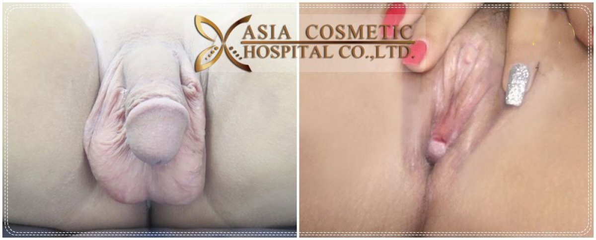 Male to female (MTF) surgery before and after results at Asia Cosmetic Hospital, gender confirmation