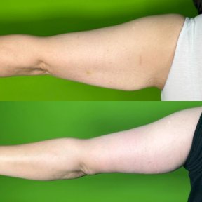 Standard Liposuction with a special discount - photo 2