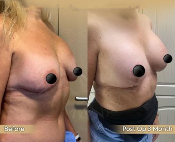 Premium Mommy Makeover Surgery-All Incluisive with European Board Certified Doctor Ali Sadioglu - photo 4