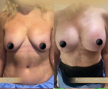 Premium Mommy Makeover Surgery-All Incluisive with European Board Certified Doctor Ali Sadioglu