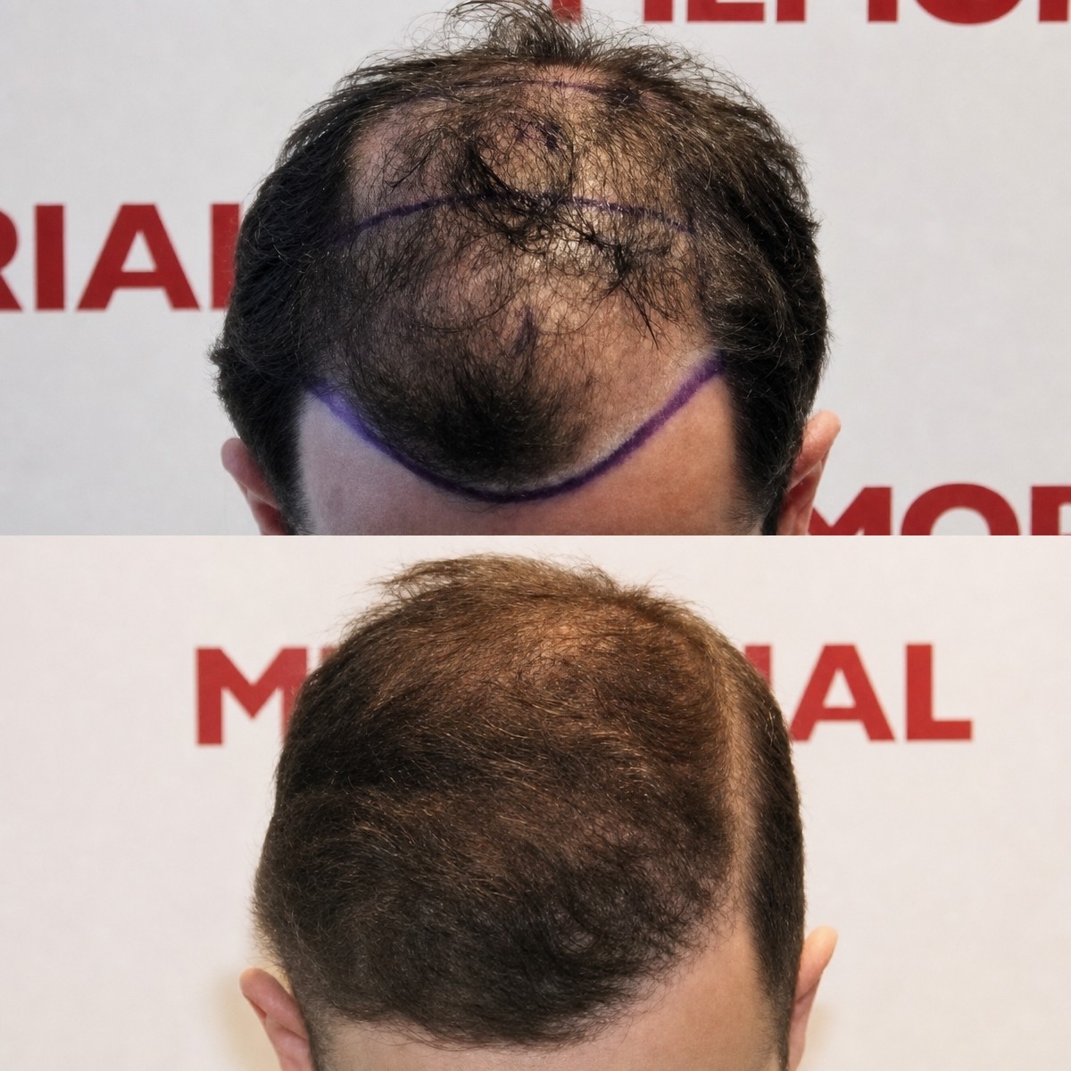 Résultats avant et après greffe de cheveux FUE à Memorial Antalya Hospital, ligne restaurée