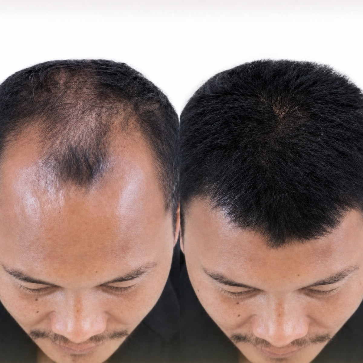Before and after FUE hair transplant results at Memorial Antalya Hospital, restored hairline