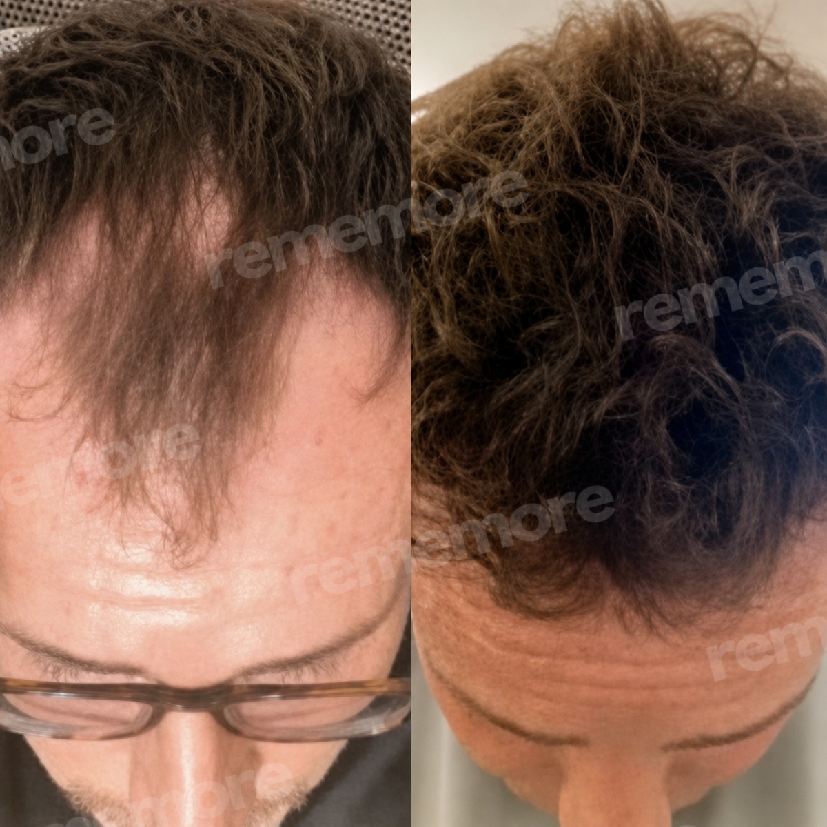 نتائج زراعة الشعر FUE قبل وبعد في مستشفى ميموريال أنطاليا، استعادة خط الشعر