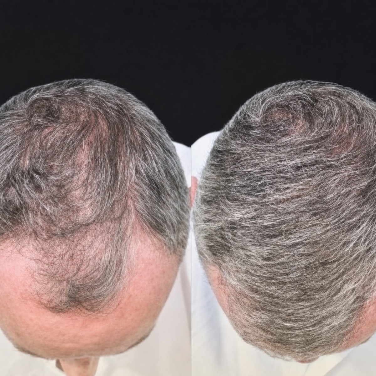 نتائج زراعة الشعر FUE قبل وبعد في مستشفى ميموريال أنطاليا، كثافة شعر محسّنة