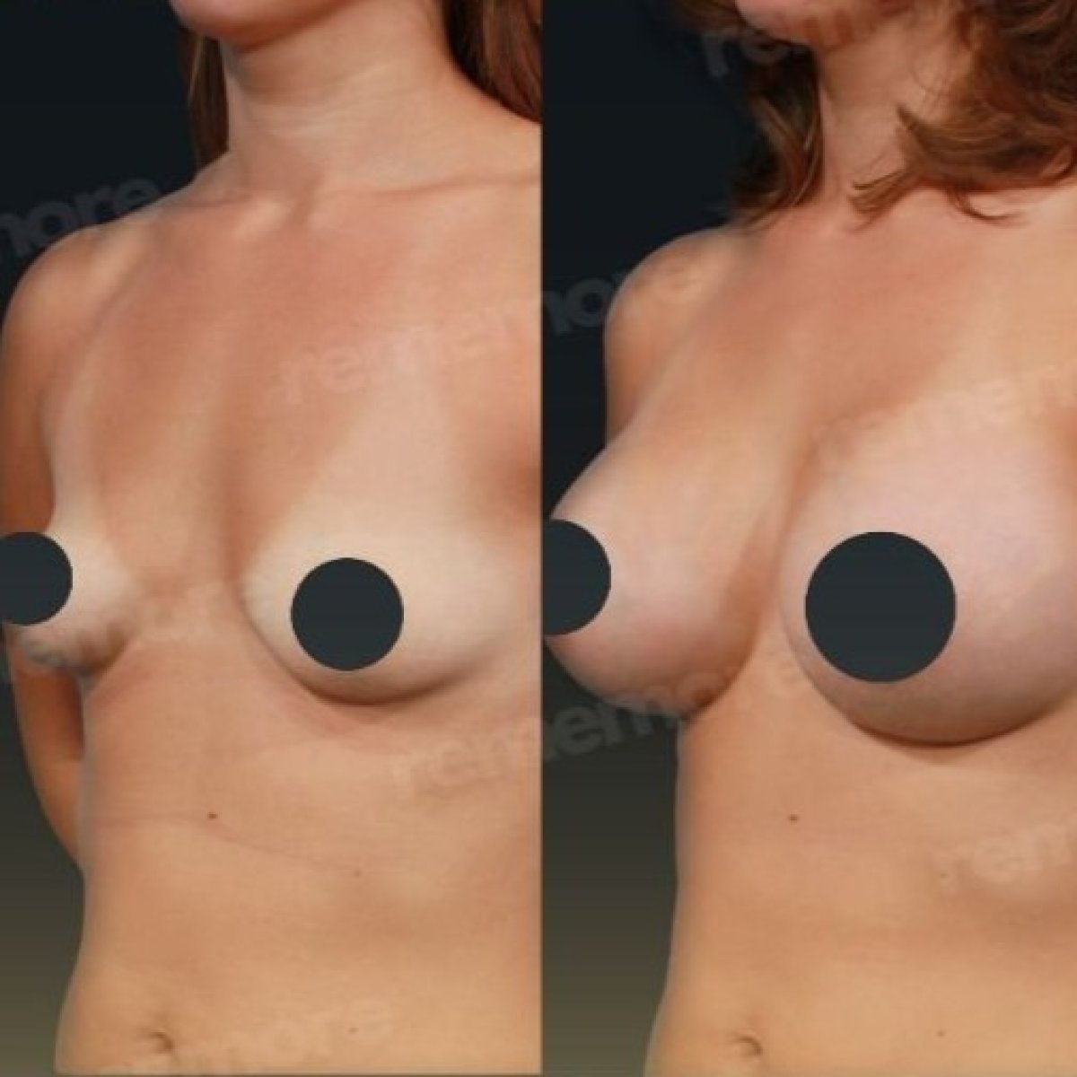 Before and after breast implants with lift results at Memorial Bahçelievler Hospital